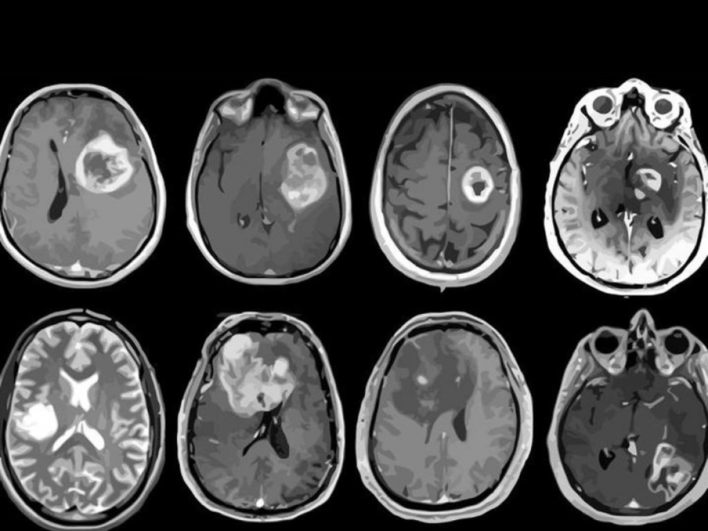 Hoy se conmemora el Día Internacional de los Tumores Cerebrales