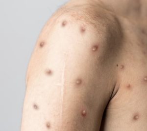 Anuncia la OMS que la “Viruela del mono deja de ser una emergencia sanitaria”