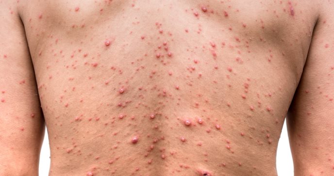 Yucatán llega a 61 casos de viruela del mono; 20 ya fueron dados de alta